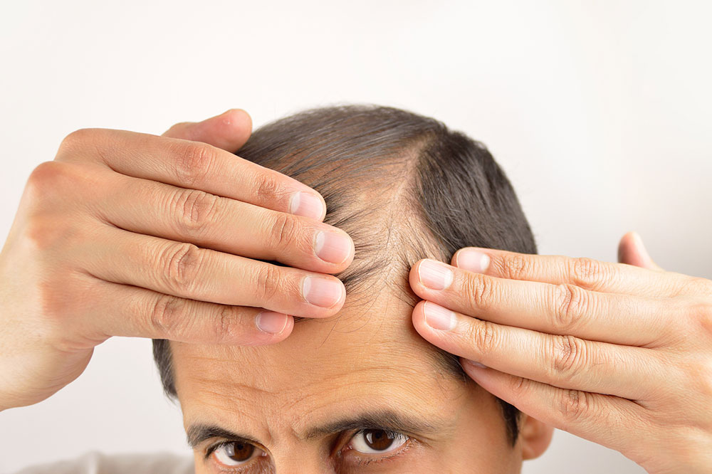 Ways to manage hair loss